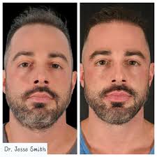 Amazing Transformation Alert! 🌟 This patient underwent a hair transplant  with Dr. Jesse Smith back in February 2024, and the results speak for  themselves! Check out the impressive regrowth and natural-looking fullness