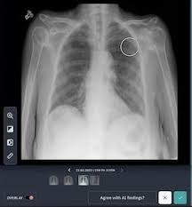 Image result for lung cancer xray