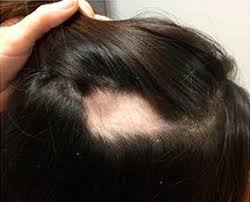 While a scalp condition such as psoriasis doesn. Alopecia Areata Boston Auto Immune Hair Loss Ma