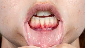 Hole In Gums Causes Symptoms Treatments And Prevention