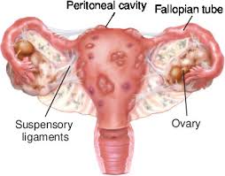 It can cause pain, infertility, and very heavy periods. Endometriosis Taber S Medical Dictionary