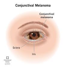 Image result for lesion sclera