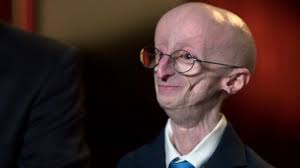 Some children with progeria receive treatment for complications from the disease, such as hardened arteries. Sam Berns Boy With Aging Disease Progeria Dies At 17 Abc News