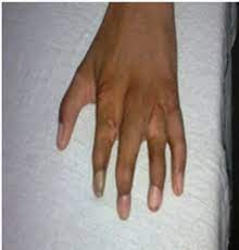 Poland's syndrome, poland anomaly, poland sequence, and poland syndactyly. A 13 Year Old Boy With Poland Syndrome Having Asymmetrical Chest Wall Download Scientific Diagram