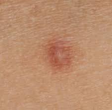 Not all skin cancers look alike. Dermofit
