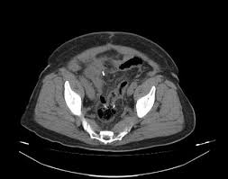 The left side of the colon has four sections: Colorectal Anastomosis Leakage Radiology Case Radiopaedia Org