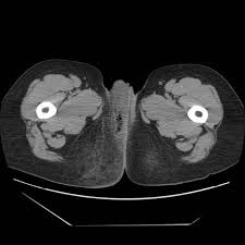 We did not find results for: Fournier Gangrene Radiology Reference Article Radiopaedia Org