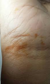 I don't know what proportion of cases where rusty spots appear on cannabis leaves are caused by rust fungus, and what proportion are caused by a nutrient deficiency. Woke Up To Orange Stained Hand The Student Room