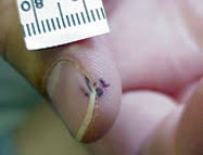 Maybe you would like to learn more about one of these? Nail Abnormalities Clues To Systemic Disease American Family Physician