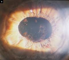 Image result for HIV Retinitis