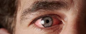 Entropium (ein nach innen gedrehtes augenlid) und trichiasis (nach innen gedrehte wimpern). Augenentzundungen Focus Arztsuche