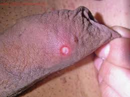 They can look like a rash, a tiny red spot, a sore or lesion, or a blister. Herpes Herpes Simplex Virus Red Book Online