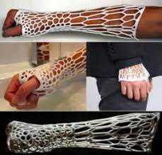 3d Printed Cast Lets Broken Arms Breathe Odor Free Impresiones En 3d Diseno Medico Diseno De Robot