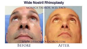 We did not find results for: Nostril Reduction Surgery In Nj Wide Nostril Nose Job