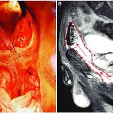 Fournier is a french surname. Fournier Gangrene Without Perineal Involvement A Representative Download Scientific Diagram