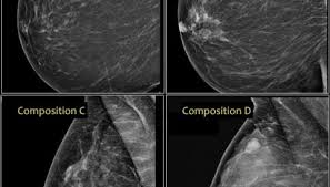 What does breast cancer look like? What Does Breast Cancer Look Like On A Mammogram Pakistan Observer