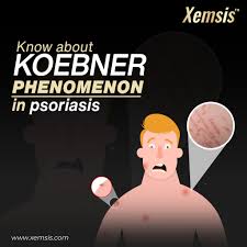 Image result for koebner phenomenon psoriasis