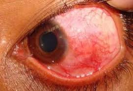 Image result for Scleritis