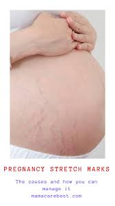 Bio Oil Pregnancy Stretch Marks Before And After Birth Pin On Pregnancy Stretch Marks Removal Or Scars Removal