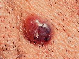 Most melanomas are either brown or black. Is It Skin Cancer 38 Photos That Could Save Your Life Pictures Cbs News