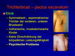 Nur ein kind von 20.000 —30.000 kinder ist betroffen, das heißt, es ist so selten. Brustkorb Und Hals Trichterbrust Kielbrust Poland Syndrom Ppt Video Online Herunterladen