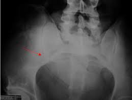 Image result for Body Stuffer