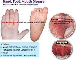 Hand Foot Mouth Disease Pediatric Nursing Pediatric Nurse Practitioner Dermatology Nurse