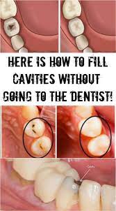 Here Is How To Fill Cavities Without Going To The Dentist Dental Caries Teeth Health Cavities