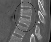 Image result for icd 10 code for compression fracture t10-t11