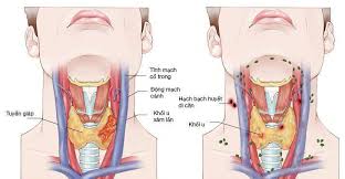 Ung thư hạ họng là những khối u xuất phát từ vùng hạ họng chia theo 3 vùng: Ung ThÆ° Vom Há»ng Giai Ä'oáº¡n Cuá»'i Di CÄƒn Antican Vn