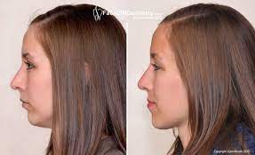 It is commonly a jaw related problem, but minor cases can be corrected with traditional dentistry. Pin On Beauty Tips