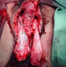 1,179 likes · 85 talking about this. Fournier S Gangrene Due To Perioperative Iatrogenic Colon Perforation In A Renal Transplant Recipient Papadimitriou G Koukoulaki M Vardas K Grigorakis A Vougas V Drakopoulos S Saudi J Kidney Dis Transpl