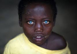 Black And Blue Eyes After Head Injury Pin Auf Eric Lafforgue