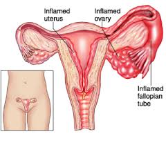 Pelvic Inflammatory Disease Information