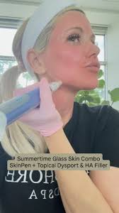 It's never too late to rejuvenate your skin with #scitonbbl ✨✨ #sciton  #scitonlaser #scitonhalo #scitonmoxi #beforeandafter #ipl #rejuvinate  #sunspots #agespots #antiage #skincaretips #skin #spf #houstontx  #houstonmedspa #thewoodlandstx