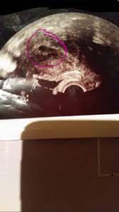 Schwanger Trotz Sterilisation Neu Hier Babycenter
