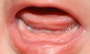 How long before pain goes away from full mouth teeth extraction? The Healed Lesion 12 Days After Tooth Extraction Download Scientific Diagram