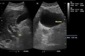 Image result for Splenomegaly