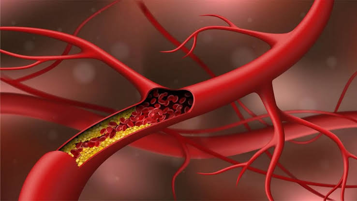 Phân loại các loại cholesterol và cách phòng tránh mỡ trong máu - Tập đoàn  y khoa Hoàn Mỹ