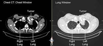 Computed tomography (ct) scans detect tumors, but do not determine whether they are malignant or not. Imaging Tests Lungevity Foundation