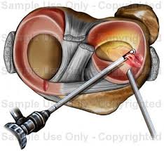 Lateral Meniscus Repair Two Incisions To Clean Up The Meniscus Knee Injury Knee Surgery Injury
