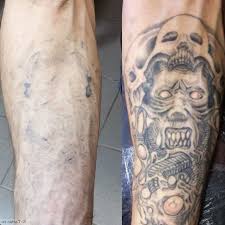 Add 1 tablespoon of baking soda and mix well Laser Tattoo Removal Features Photo Video Contraindications The Best Of 2021