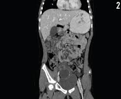 A 7 Year Old Girl With Right Lower Abdominal Pain What S The Cause Consultant360