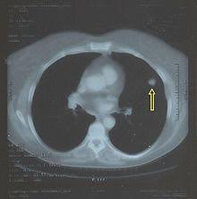 Tecnica del dott salvatore spagnolo pubblicata negli stati uniti nel testo di cardiochirurgia: Studio Tc Del Polmone Wikipedia