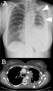 Treatments range from traditional chemotherapy to radical procedures to remove the pleural mesothelioma is a type of cancer caused by inhaling asbestos fibers. Figure 2 From Oral Presentation Of Malignant Mesothelioma Semantic Scholar