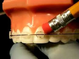 Press the wax over the painful area. Handling Out Of Town Emergencies At Reynolds Orthodontics