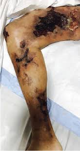 The term stable eschar is used to describe leathery, dry hard eschar tissue, such as the eschar that commonly forms on the heels or other bony prominences of the lower. Calcific Uremic Arteriolopathy Cleveland Clinic Journal Of Medicine