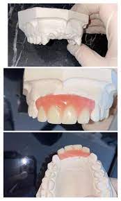 1.1 make your own dentures kit with dvd. Diy Partial Denture Kit Dental Bridge Flipper Teeth Acrylic Etsy Partial Dentures Denture Dental Bridge