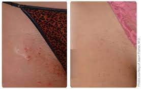 Our affordable laser hair removal service is setting the bar for permanently removing unwanted hair. Laser Hair Removal Dallas Off 79 Online Shopping Site For Fashion Lifestyle