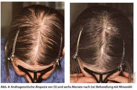 Die meisten menschen klagen über lichter werdendes haar im alter. Haarausfall Bei Frauen Ursachen Und Behandlung Doctors Today